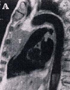 Brugada型心電図を示した縦隔腫瘍のMRI像