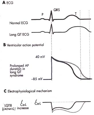 Ca電流増大が心筋細胞内電位持続時間の延長を起こし、これが心電図のQT時間延長を起こす機序を説明する模型図