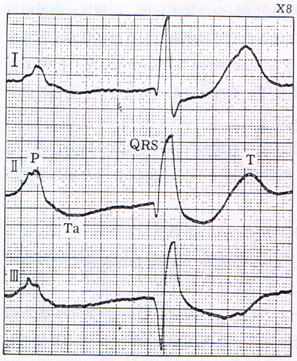 心房性Ｔ波（高感度心電図）