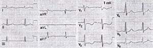 Andeersen症候群の心電図