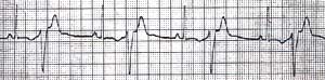 Andersen症候群例の心室性期外収縮二連脈 