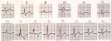 二次孔型心房中隔欠損症の心電図（右室拡張期性負荷）