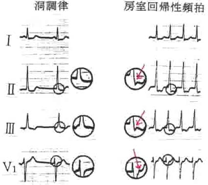 房室結節回帰性頻拍の心電図の特徴
