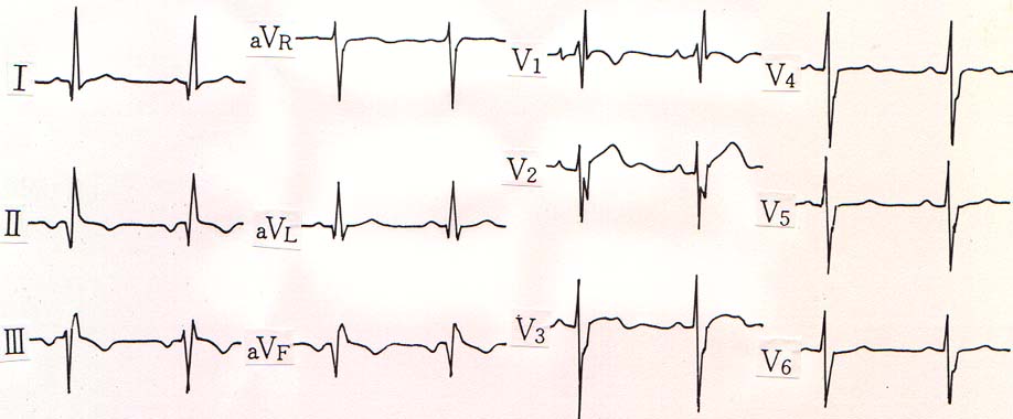 症例３の心電図
