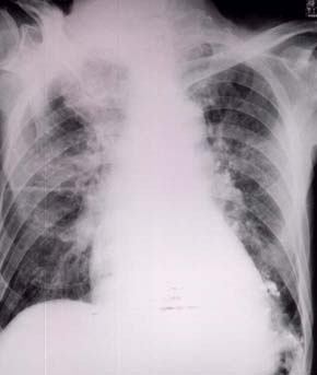 本例の入院時胸部X線写真（肺炎像）