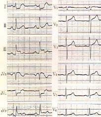 近医受診時（１０時２３分）の心電図