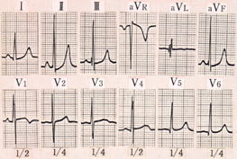 肺高血圧を伴う動脈管開存症の心電図（両室負荷）