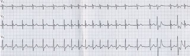 Ｊ波が著明な45歳女性の頻脈発作時心電図