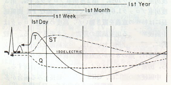急性心筋梗塞時の特徴的心電図所見の経時変化曲線