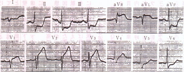 左冠動脈主幹部閉塞の心電図