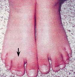 第2,3趾の左右対照的な合指症