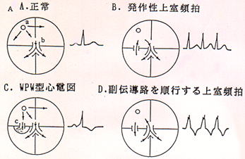 正常、WPW型心電図、房室回帰性頻拍、antidromic tacycadiaの際の興奮旋回路と心電図