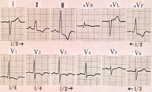 肺動脈狭窄症の心電図（右室収縮期性負荷）
